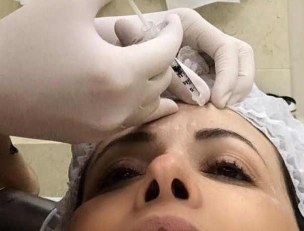 Eu faço botox e preenchimento!!