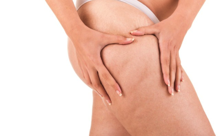 Celulite! Dieta e exercícios realmente acabam com ela?